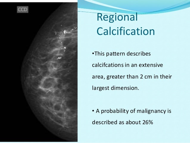 breast ducts calcium deposits Breast ducts calcium deposits